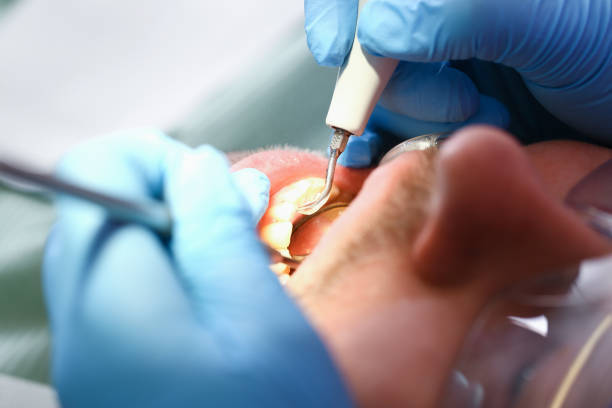 Best Emergency Dental Extractions in Gladstone, MO